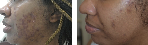 Before & After 1 Treatments