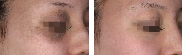 Before & After 3 Treatments