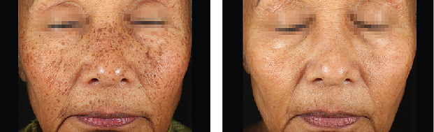 Before & After 3 Treatments