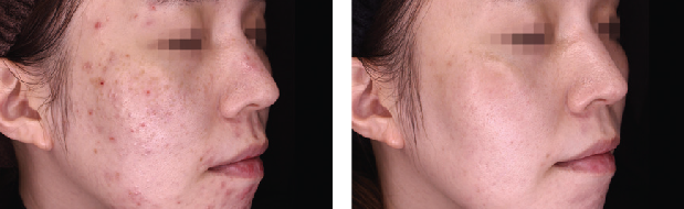 Before & After 3 Treatments