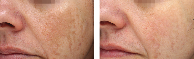 Before & After 3 Treatments