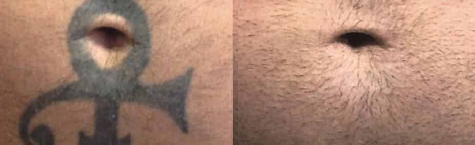 Before & After 4 Treatments