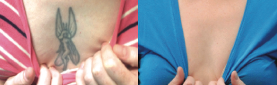 Before & After 4 Treatments