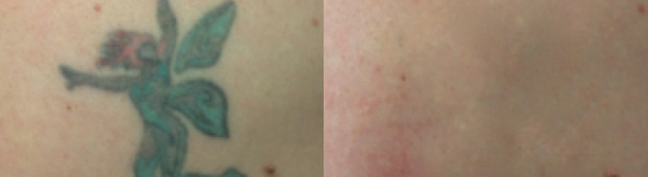 Before & After 5 Treatments