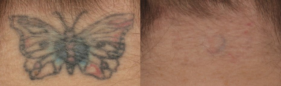 Before & After 6 Treatments