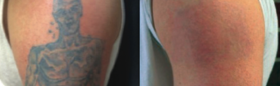 Before & After 8 Treatments