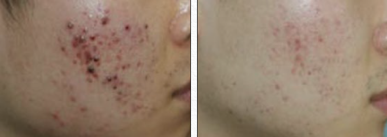 Moderate Pustular Acne