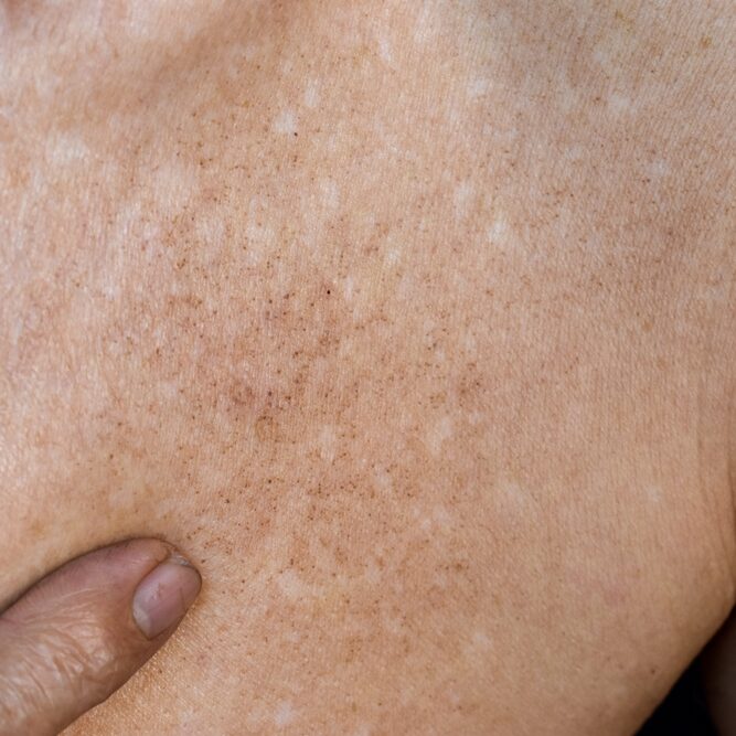 Age,Spots,And,White,Patches,On,Chest,Of,Asian,Elder