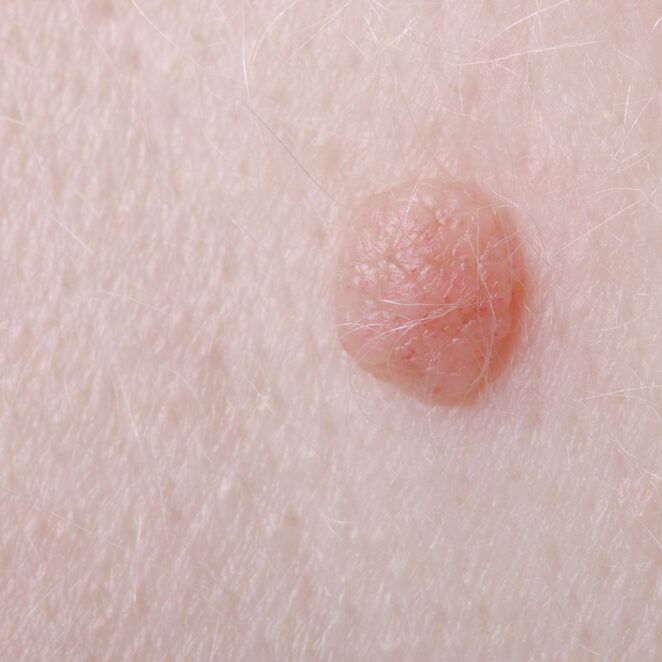 Wart,On,A,Person's,Hand,Close,Up