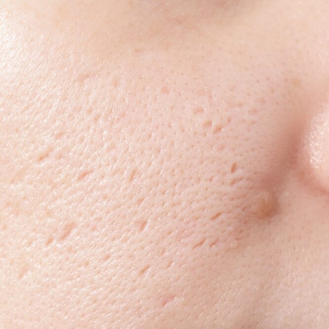 Close,Up,Of,Woman,Face,Has,Problems,With,Skin,On