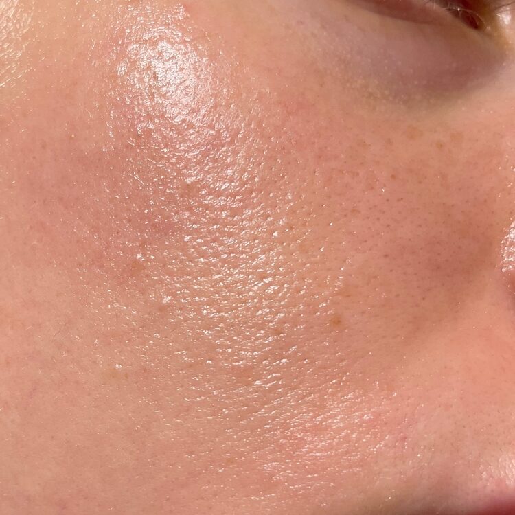 Close-up,Girl,With,Sweaty,Skin,On,Her,Face,And,Excessive