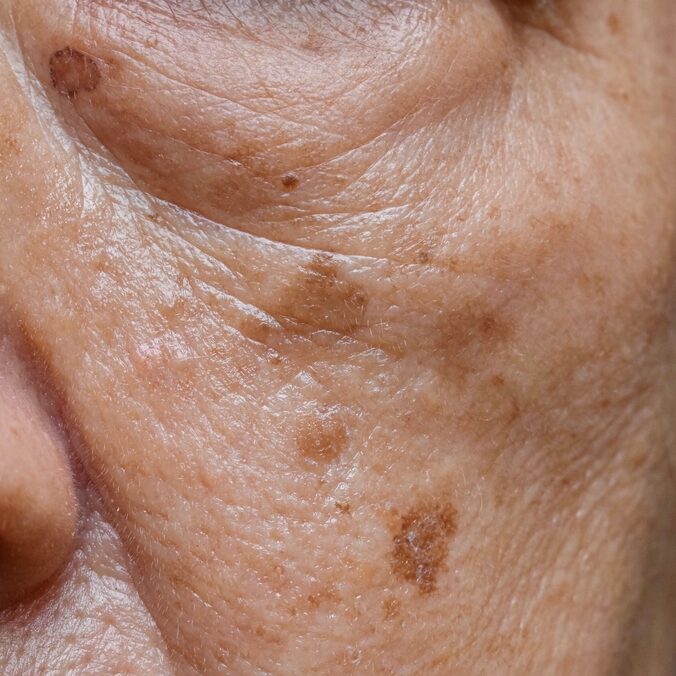 Small,Brown,Patches,Called,Age,Spots,On,Face,Of,Asian
