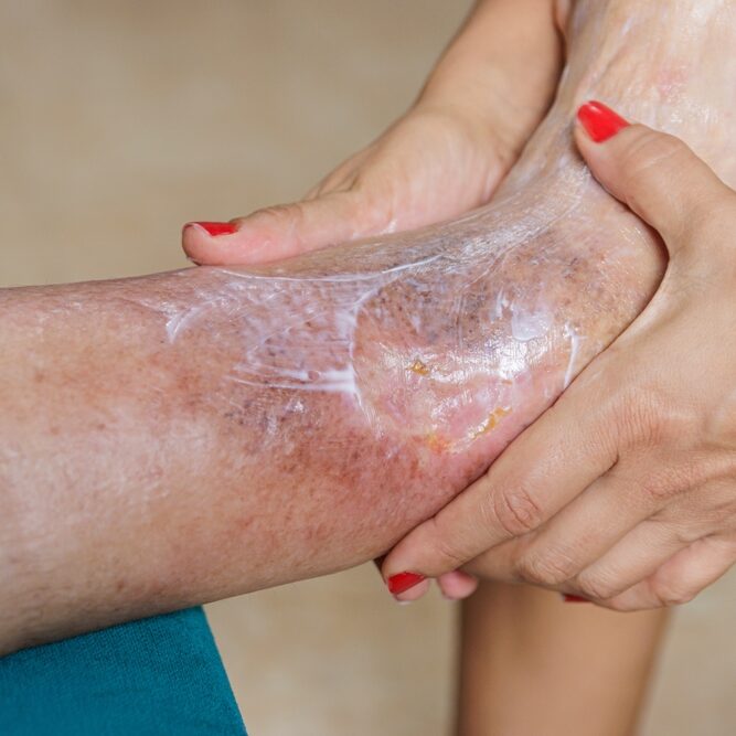 Home,Health,Care,For,An,Elderly,Person.,Leg,With,Ulcer