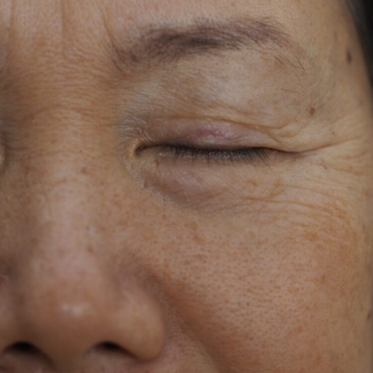 The,Aging,Wrinkles,Around,The,Eyes,Known,As,"crow's,Feet"